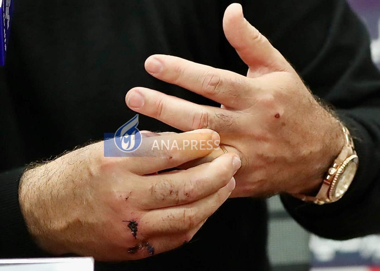 عکس| جراحت شدید ریکاردو ساپینتو؛ بخیه های عجیب روی دست سرمربی استقلال عکس| جراحت شدید ریکاردو ساپینتو؛ بخیه های عجیب روی دست سرمربی استقلال | دیلی فوتبال