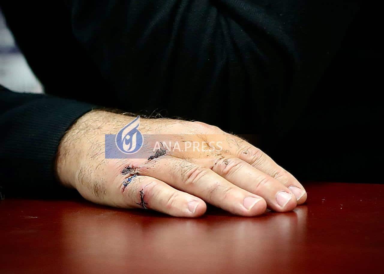 عکس| جراحت شدید ریکاردو ساپینتو؛ بخیه های عجیب روی دست سرمربی استقلال عکس| جراحت شدید ریکاردو ساپینتو؛ بخیه های عجیب روی دست سرمربی استقلال | دیلی فوتبال