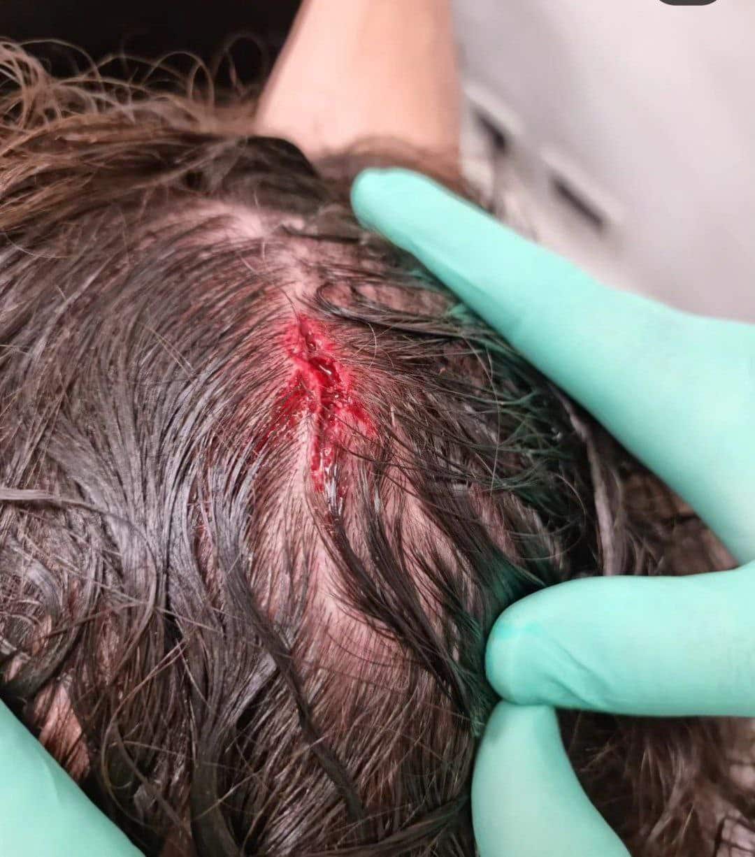 عکس| کتک خوردن و زخمی شدن زلاتان ابراهیموویچ از ناحیه سر عکس| کتک خوردن و زخمی شدن زلاتان ابراهیموویچ از ناحیه سر | دیلی فوتبال